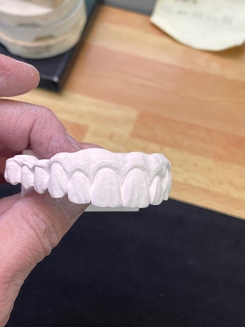 dents prothèse céramique