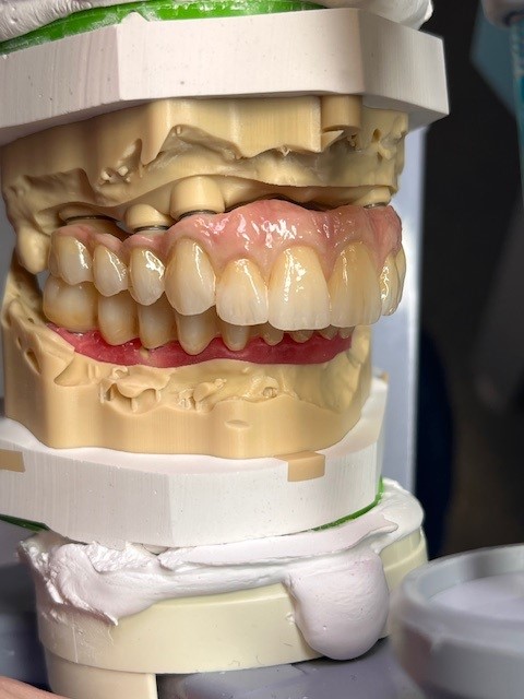 dents céramiques peintes hauts et bas 
