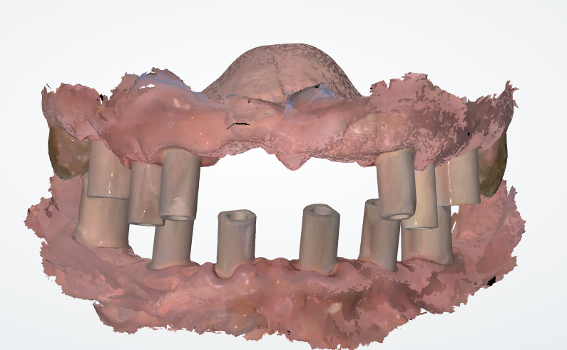 sanner des dents étape 1